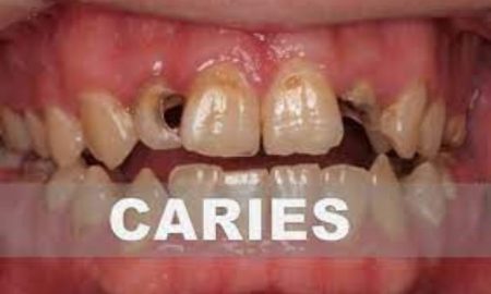 45% des Algériens ont une haleine qui sent mauvais et 70% ont des dents pleines de caries