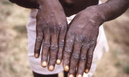 58 personnes sont mortes du monkeypox en République démocratique du Congo depuis janvier