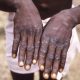 58 personnes sont mortes du monkeypox en République démocratique du Congo depuis janvier