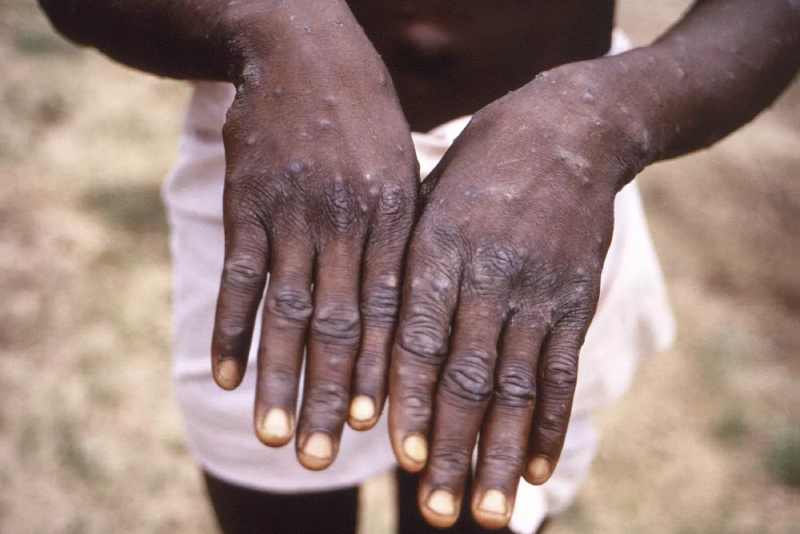 58 personnes sont mortes du monkeypox en République démocratique du Congo depuis janvier