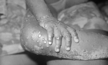 Le Kenya nie avoir enregistré un cas de monkeypox