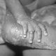 Le Kenya nie avoir enregistré un cas de monkeypox