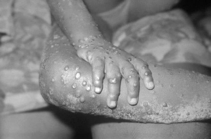 Le Kenya nie avoir enregistré un cas de monkeypox