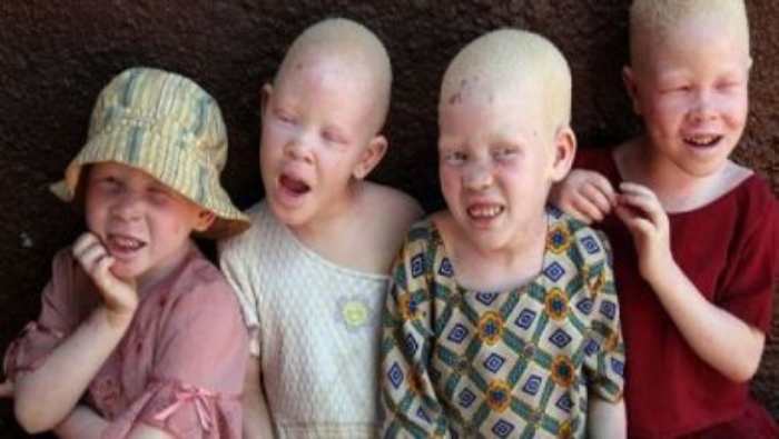 Un tribunal du Malawi condamne de trois à 155 ans de prison pour meurtre d'albinos