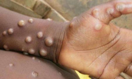 "Histoire de son apparition et de ses symptômes"..."Monkeypox" traverse l'Afrique et envahit le monde