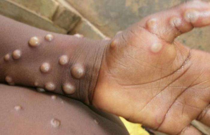 "Histoire de son apparition et de ses symptômes"..."Monkeypox" traverse l'Afrique et envahit le monde