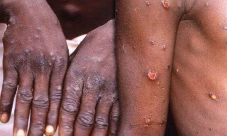 Décès par monkeypox signalés dans les pays africains