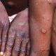 Décès par monkeypox signalés dans les pays africains