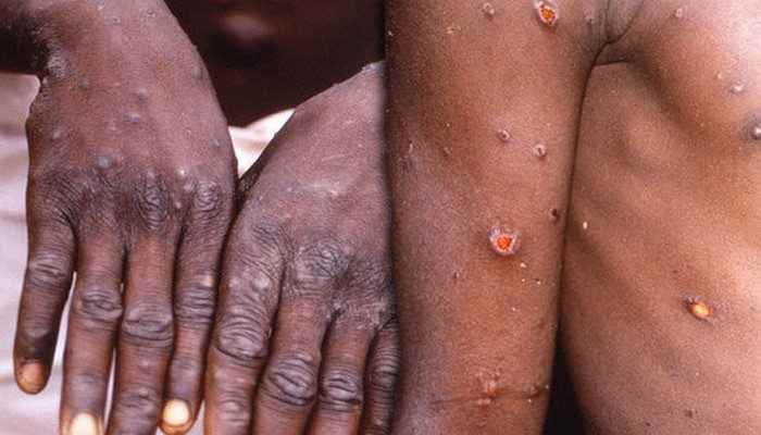 Décès par monkeypox signalés dans les pays africains