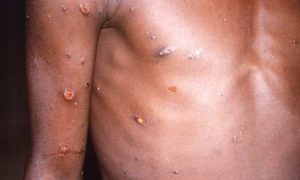 Monkeypox...Le Nigeria annonce 21 cas depuis le début de l'année et un décès