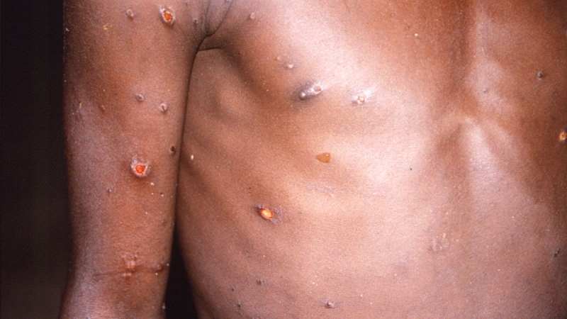 Monkeypox...Le Nigeria annonce 21 cas depuis le début de l'année et un décès