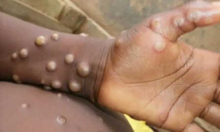 Le nombre de cas de monkeypox au Nigeria est passé à 220