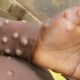 Le nombre de cas de monkeypox au Nigeria est passé à 220