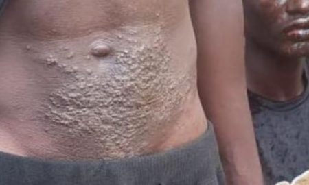 Guinée : Les autorités lancent une enquête après que des dizaines de pêcheurs souffrent de problèmes de peau
