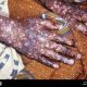 L'anthrax...Une maladie grave se propage au Ghana
