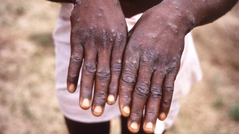 Santé mondiale : Les cas de « variole du singe » en RDC constituent un danger mondial