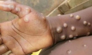 RD Congo: Des experts en maladies infectieuses coordonnent leurs efforts contre la variole du singe