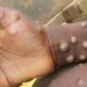 RD Congo: Des experts en maladies infectieuses coordonnent leurs efforts contre la variole du singe