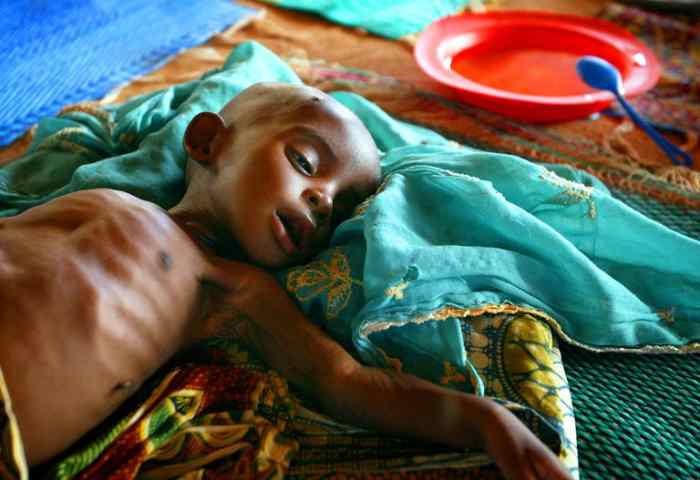 Des millions d'enfants au Soudan risquent de souffrir de malnutrition sévère