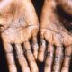 L'Afrique du Sud connaît son premier cas de variole du singe